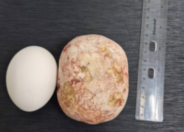 Саратовские врачи вытащили килограммовый камень из мочевого пузыря 65-летнего пациента